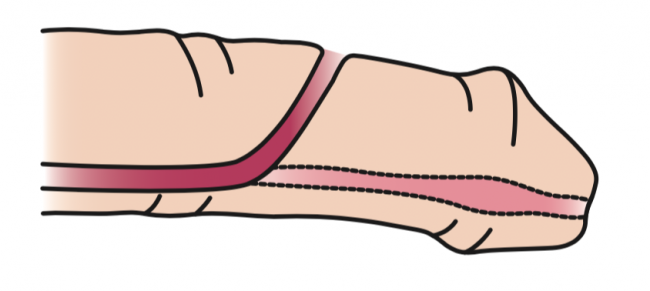 Epispadias Epispadias