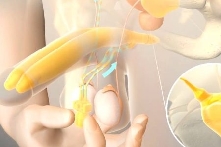 penis protezi, mutluluk çubuğu