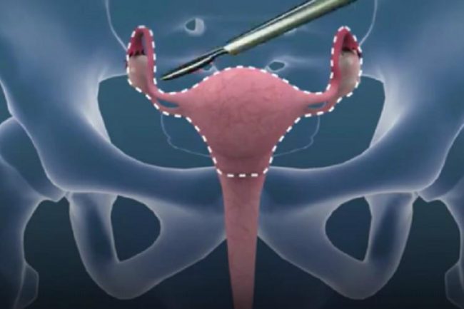 sex reassignment surgery sex reassignment surgery